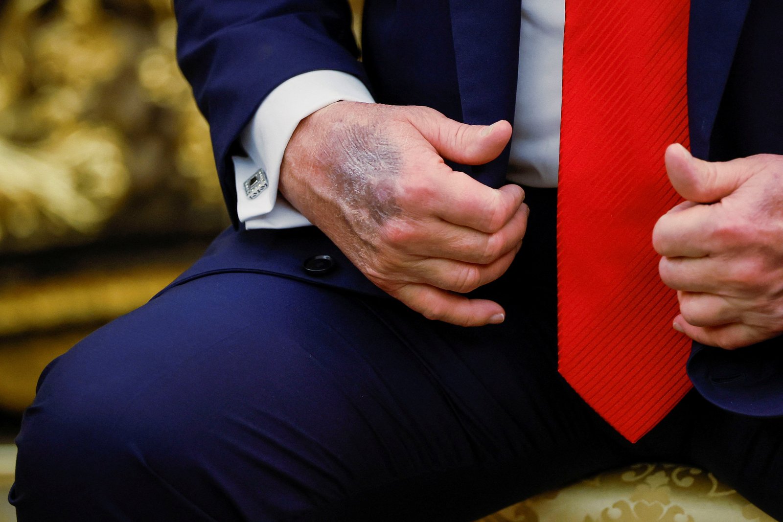 A bruise on Trump's hand, depicted on August 25th. The president was diagnosed with chronic venous insufficiency this summer
